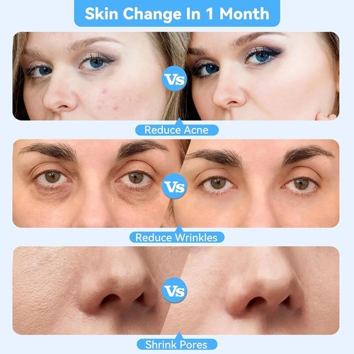Upgraded Diamond Microdermabrasion Machine Blackhead Removal Professional Facial - Picture 3 of 9