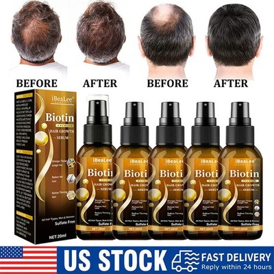 Biotin Hair Growth Spray Anti Hair Loss Fast Regrowth Scalp Treatment Serum US