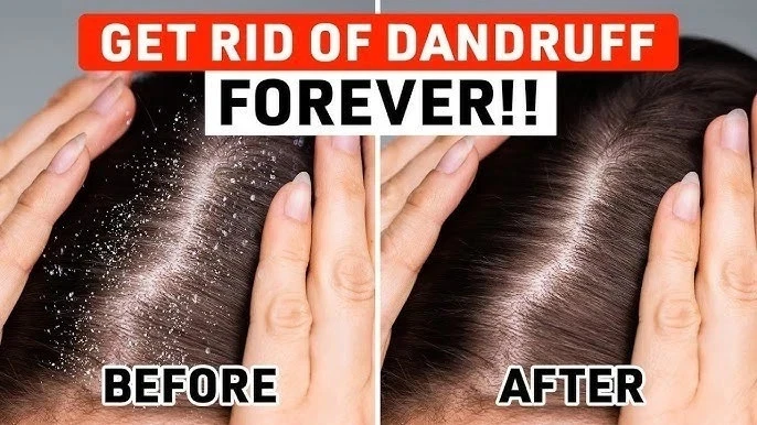 Champú anticaspa KETOSHAMPOO para mujeres y hombres cuidado del cabello | Paquete de 100 ml x 3. Foto 4 de 4