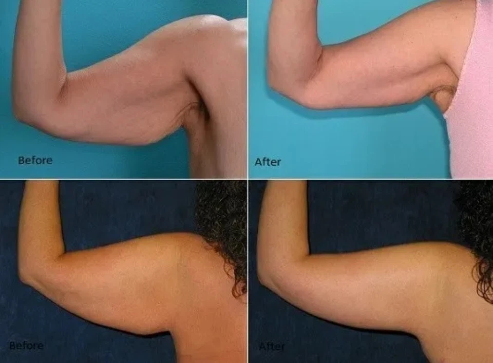 2 Flabby saggy arms no more 奶油紧致纤薄收紧脂肪团快速工作 — 第 2/4 张图片