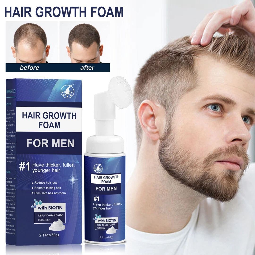 Update 144+ hair growth treatment for men latest tnbvietnam.edu.vn
