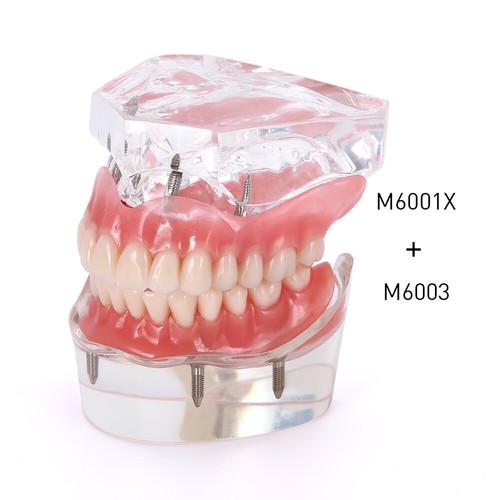 US Dental Implant Teeth Model Demo Overdenture Restoration With Implants U/L - Picture 23 of 27