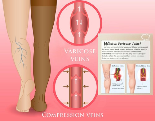 UNISEX Medical Grade Compression 15-46mmhg, Stockings, Tights, for Support - Picture 7 of 51
