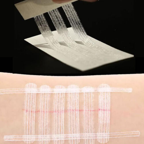 Sterile First Aid Wound Skin Closures Surgical Adhesive Steri Strip Skin Rep-lk - Bild 2 von 17