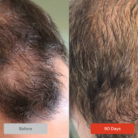 Spectral Mens (Spectral DNC-N&reg;) Hair Serum w/ Nanoxidil 5% by DS Laboratories