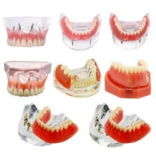 Dental 2/4 Implant Overdenture Restoration Upper Lower Teeth Model Typodont