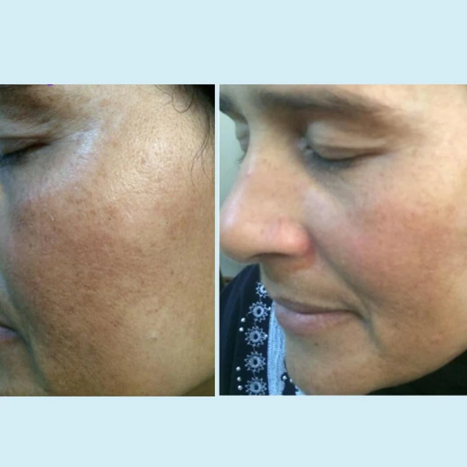 Exfoliante en gel Lactic 50 %, exfoliante químico para cicatrices de ruptura facial, exfoliante químico Foto 4 de 4