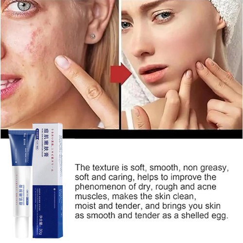 Anti Pimple Oil Control Face Cream Facial Soothing Care Ointment Even Complexion - Picture 4 of 12