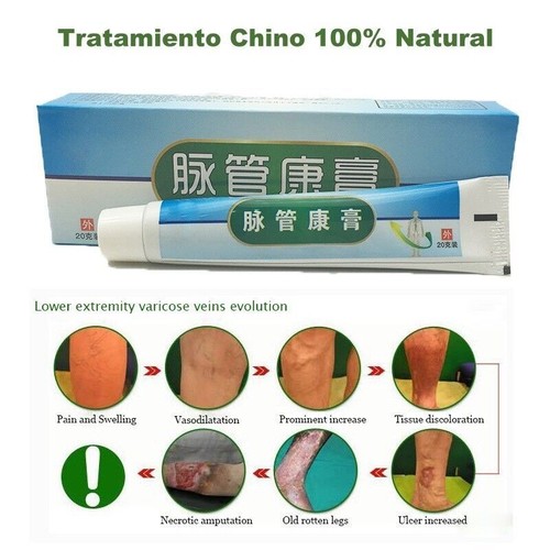 Crema Para Eliminar Rápido Las Varices Y Arañitas Vasculares Tratamiento NATURAL - Picture 4 of 6
