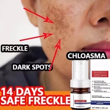 Whiting And Freckle Removing Serum Cream Dark Spot R𝐞mover Freckle Cream Serum