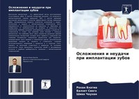 Oslozhneniq I Neudachi Pri Implantacii Zubow Shiwa Chauhan