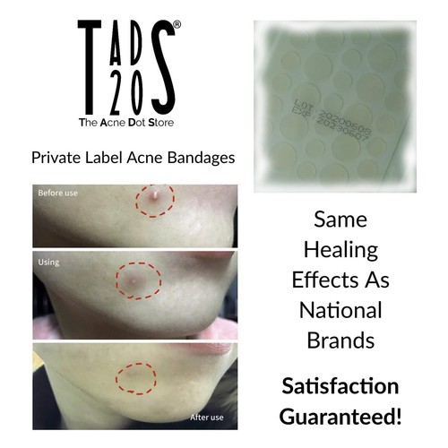 200 Small Zit Stickers, Cystic Acne Patches TADS20 Spot Bandages PLANT BASED - Picture 8 of 12