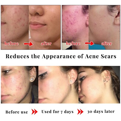 Savon Kojie San Acid Kojic - Atténue Taches Et Acné - 100g - Origine Thaïlande