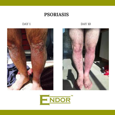 Psoriasis: Remove scaly hardened skin back to naturally beautiful skin
