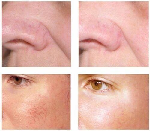 Lux Vitamin K Cream - Eliminate Spider Varicose Veins Scars Rosacea Capillaries - Picture 5 of 8