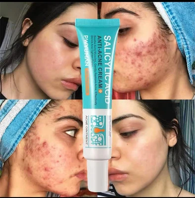 NEXTFIND Salicylic Acid Strong Acne Removal Cream Anti Acne Pimple Scars Spots Clean Uk