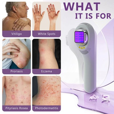 308nm Home Phototherapy UVB Light Lamp Device for Skin Diseases Treatment KTS