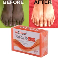 Kojic Acid Soap Dark Spot Remover Skin Lightening Face Whitening Body Bleaching