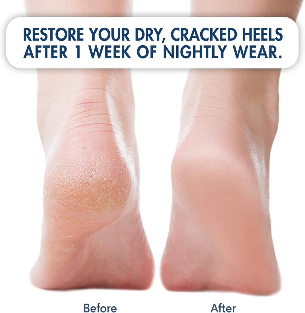 How to Prevent Cracked Heels? - Dr Venus