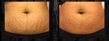 STRETCH MARK FADE  TREATMENT OIL...STRETCH MARK OIL