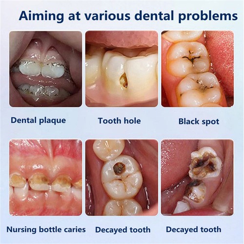 Upgrade Quick Repair of Cavities Caries Removal of Plaque Stains Toothpaste 120g - Picture 11 of 13