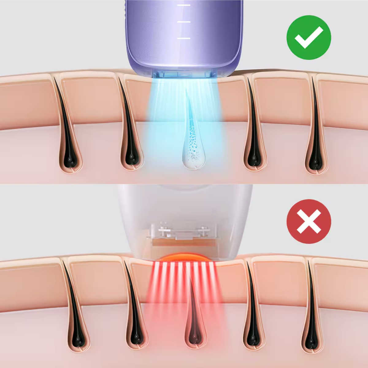 Ulike IPL Hair Removal Device Air3 新品未使用 Amazon.com: Ulike Laser Hair Removal, Air 3 IPL Hair Removal with