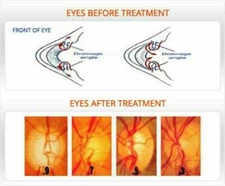 3X Eye Drops OFFICIAL USA Care Glaucoma Best For Eye Problem Cataract low price