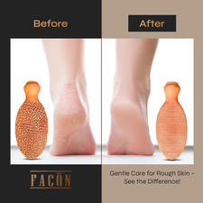 Fac n Pumice Stone for Feet Callus Remover - Terra-Cotta Foot Scrubber with 2...