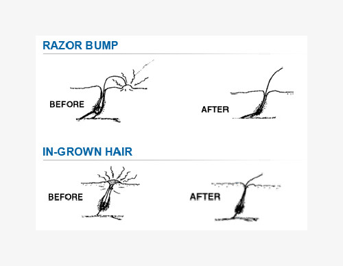 Tend Skin Razor Rash Bumps Ingrown Hairs Tendskin Ingrowing Hair