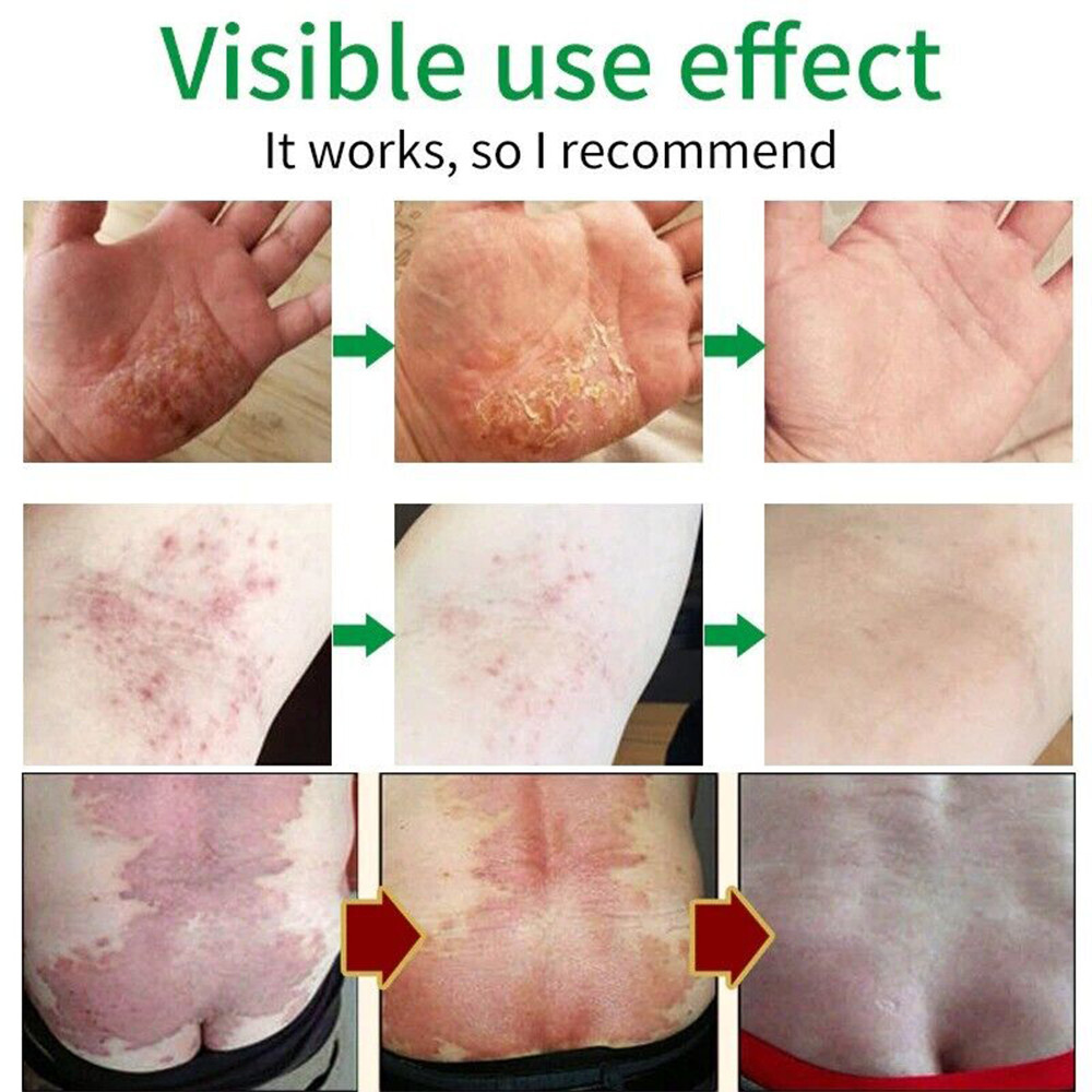 TINEA VERSICOLOR Antifungal Herbal Cream Treats Eczema Itch Skin Rash