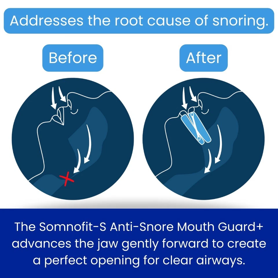 Somnofit-S Anti-Snore Mouth Guard+ | Luxury Snoring Mouthpiece | Swiss Made - Image 2 of 4