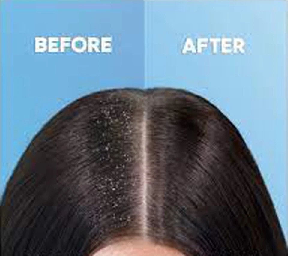 Anti Dandruff Shampoo for Oily Sensitive Scalp Prone to Dandruff & Folliculitis - Image 4 of 4