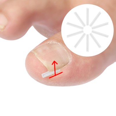 Strisce Correttore Per Unghie Incarnite, Kit Di Correzione Per Unghie Spesse In Plastica