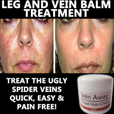 VENEN WEG CREME LOTION ENTFERNEN FADEN VENEN BESENREISER GESICHT UND KÖRPER