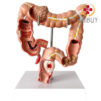 PVC Human Large Intestine Anatomical Model 1:1 Human Colonic Pathology Model