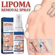 50ML Lipomheilung Reduction Spray, Instant LumpFree Lipoma Removal Spray USA Hot