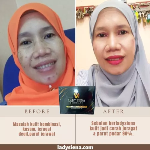 GOLD TRIAL SET Stubborn Spot Whitener EFFECTS LADYSIENA'S BLACK SCAR WITH HOLE
