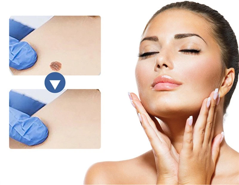 Skin Tag Remover Patches Quick Effective Mole and Wart Pad Removal Sticker US - Image 4 of 4