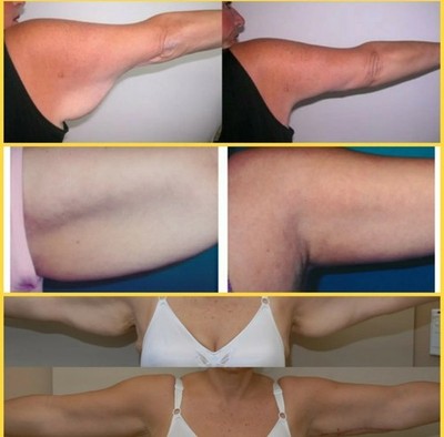 Flabby saggy arms double chin firming cream wrinkle remover cellulite reducer 