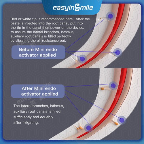 Dentale Endo Attivatore Sonico Easydo Irrigatore Canale Radice Pulizia + 45/60 Punta X-ROOT - Foto 21 di 29