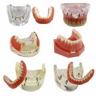 <!--F#f_0-->Dental Implants Restoration Model Overdenture Inferior With Demo Teaching Study <!--F/-->