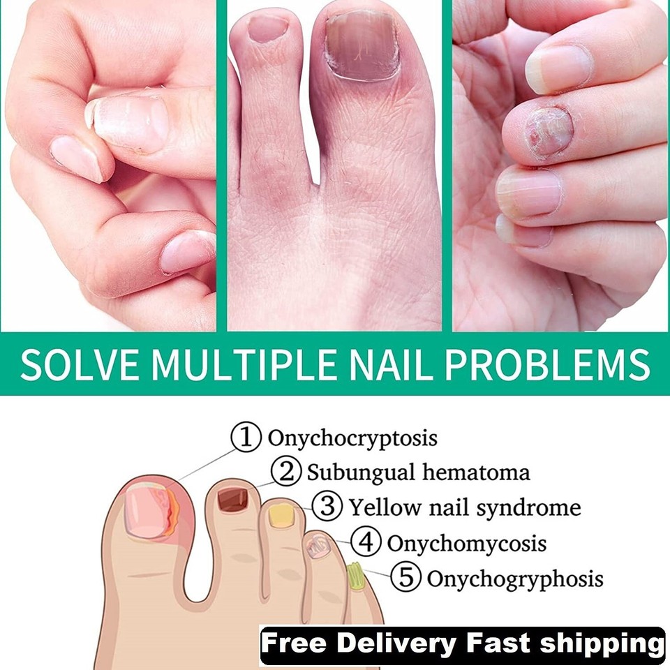 Kerassentials For Toenail Fungus Kerassentials Toenail Fungus Kerassentials for toenail fungus kerassentials toenail fungus