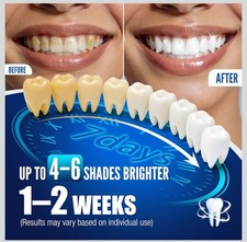 Teeth Whitening Pen Kit - 35 Carbamide Peroxide, Stain Removal, 4 Whitening Pen