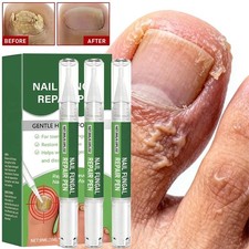 Premium Pen Antifungal Toenail Fungus Treatment Extra