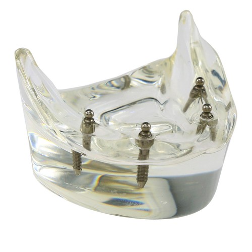Multiple Types Dental Teeth Model Ortho Implant Practice Teaching Demo Model - Picture 96 of 276