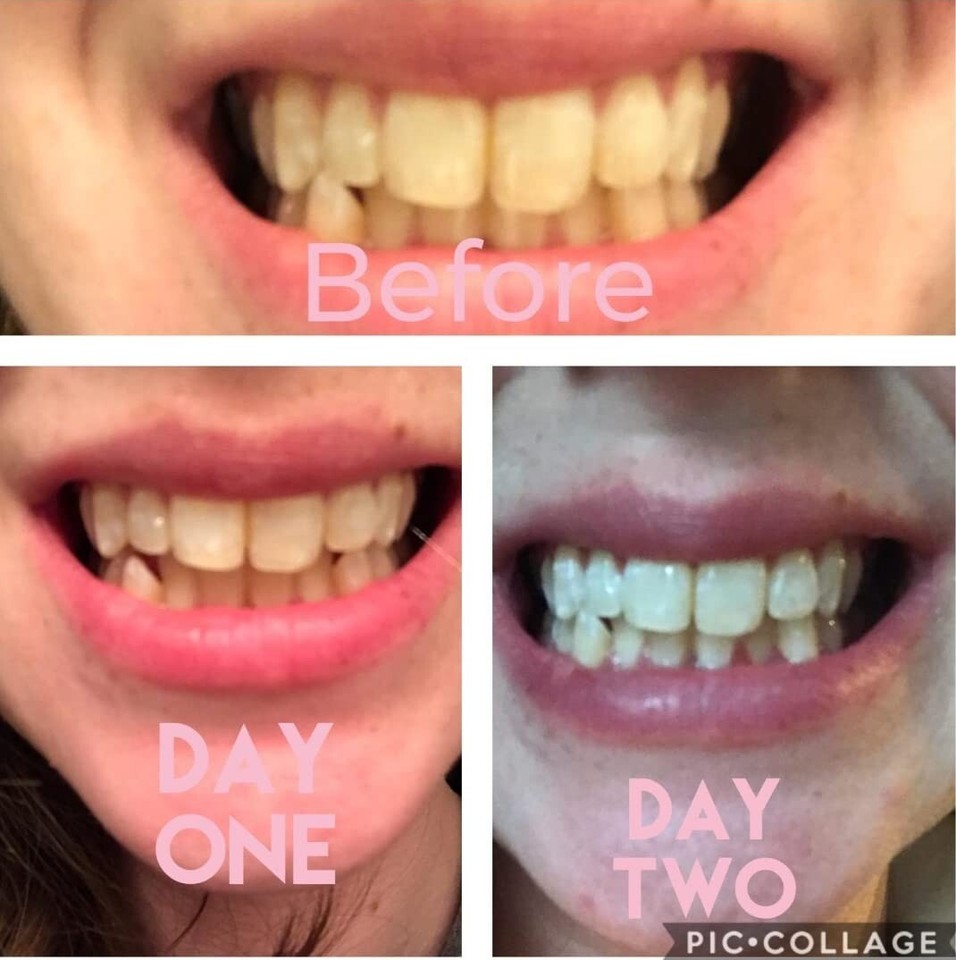 SHIP NOW Smile Titan Teeth Whitening Kit 5X LED Accelerator Light