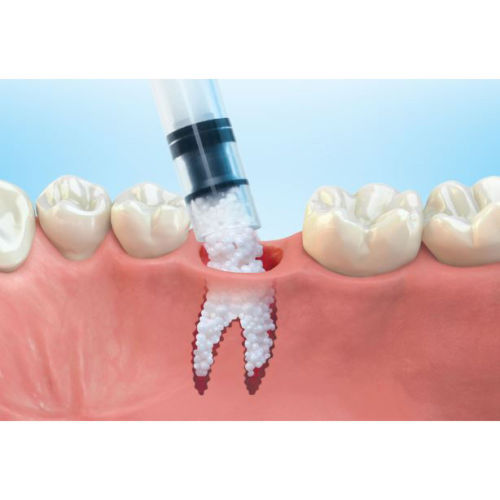 Zenoss Plus Xenograft Bovine Gel Bone Graft Paste Material 0.5 cc ...