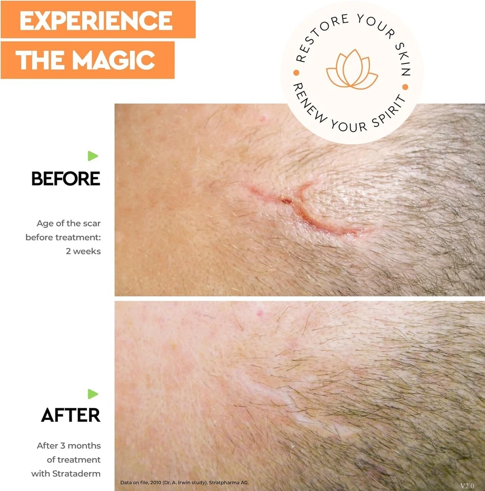 Strataderm Professional Scar Therapy Gel | Old and New Scars from General Surger - Image 3 of 4