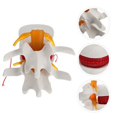 1Pc Human Spine Model Lumbal Disc Herniation Präsentationsmodell für die Schule