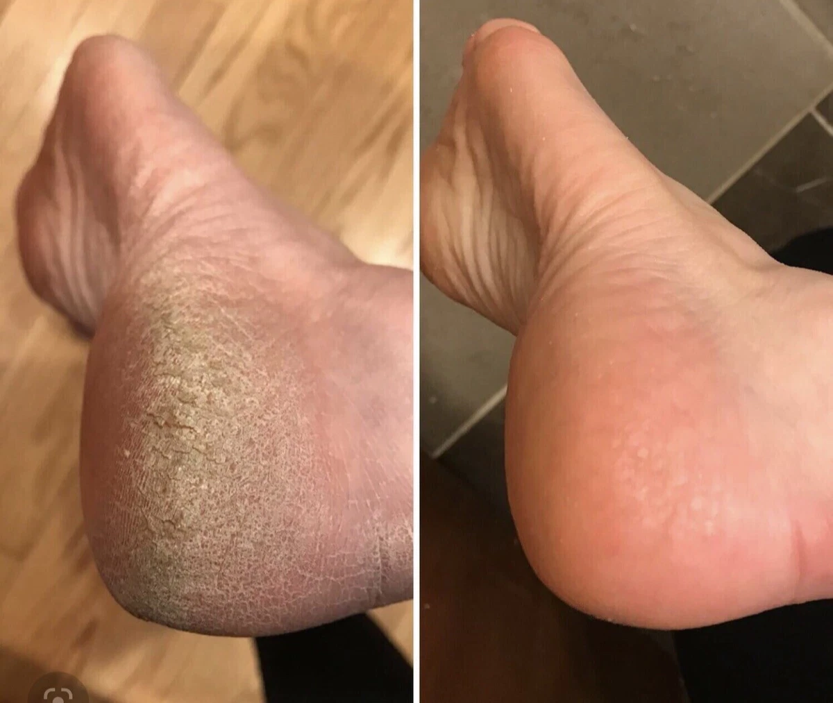 Best cream for store cracked skin on feet